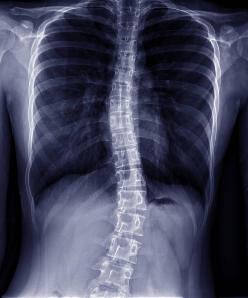 Right Thoracic Scoliosis